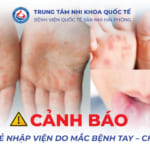Cảnh báo gia tăng trẻ nhập viện do mắc bệnh tay – chân – miệng